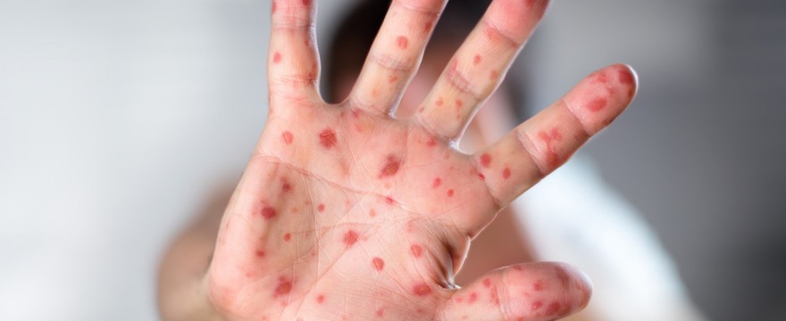 Wysypki, pęcherze i owrzodzenia – to mogą być objawy bakteryjnej infekcji skóry